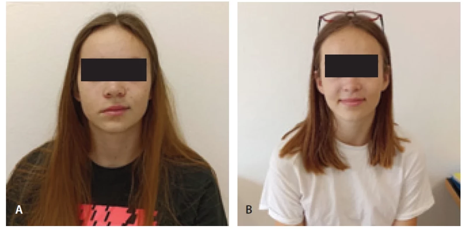 (A) 16letá dívka s idiopatickou periferní parézou. (B) Po 4 týdnech 3× denně s Rehamime.