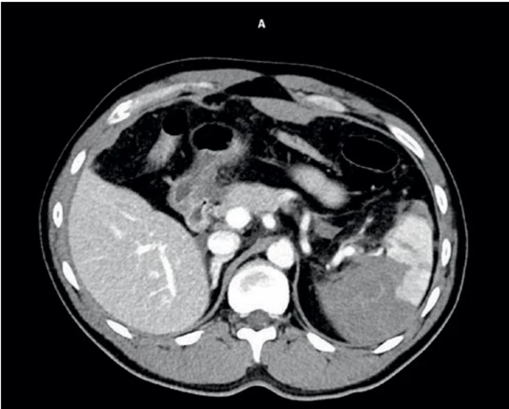 Úrazové CT druhého pacienta.  Injury CT scan of the second patient.