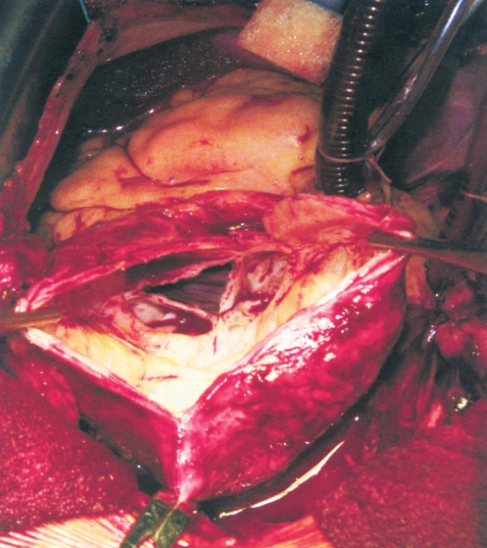 Pohled na aortální chlopeň (trojcípá, ztluštěná, centrální otvor způsobující regurgitaci)
Fig. 2. View of the aortic valve (the tricuspid, thickened, the central opening causing regurgitation)