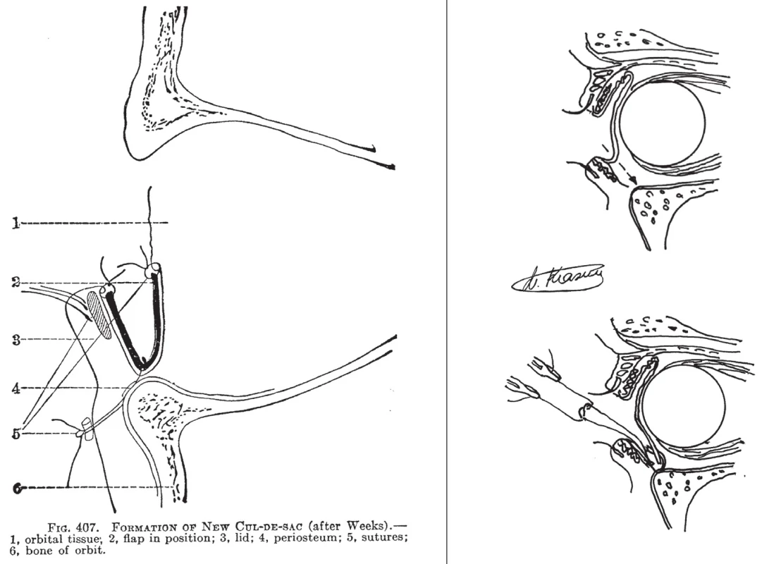 Chirurgické techniky
A – operace cul-de-sac podle Weekse (převzato z Fuchs, H.E. &amp; Duane, A.: Text-Book of Ophthalmology, 1923)
B – schéma operace: řez na hranu očnice (nahoře) a fixační stehy do periostu (dole)