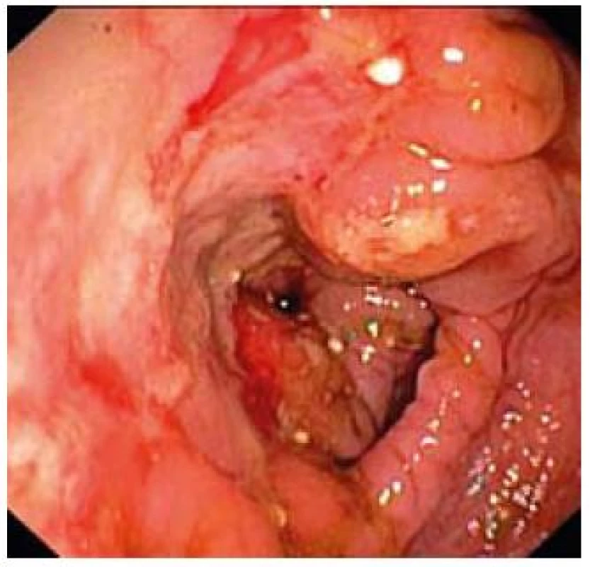 Edém, ulcerácie, kontaktné krvácanie sliznice colon transverzum.
Fig. 1. Swelling of mucosa, ulcerations, contact bleeding in colon transversum.