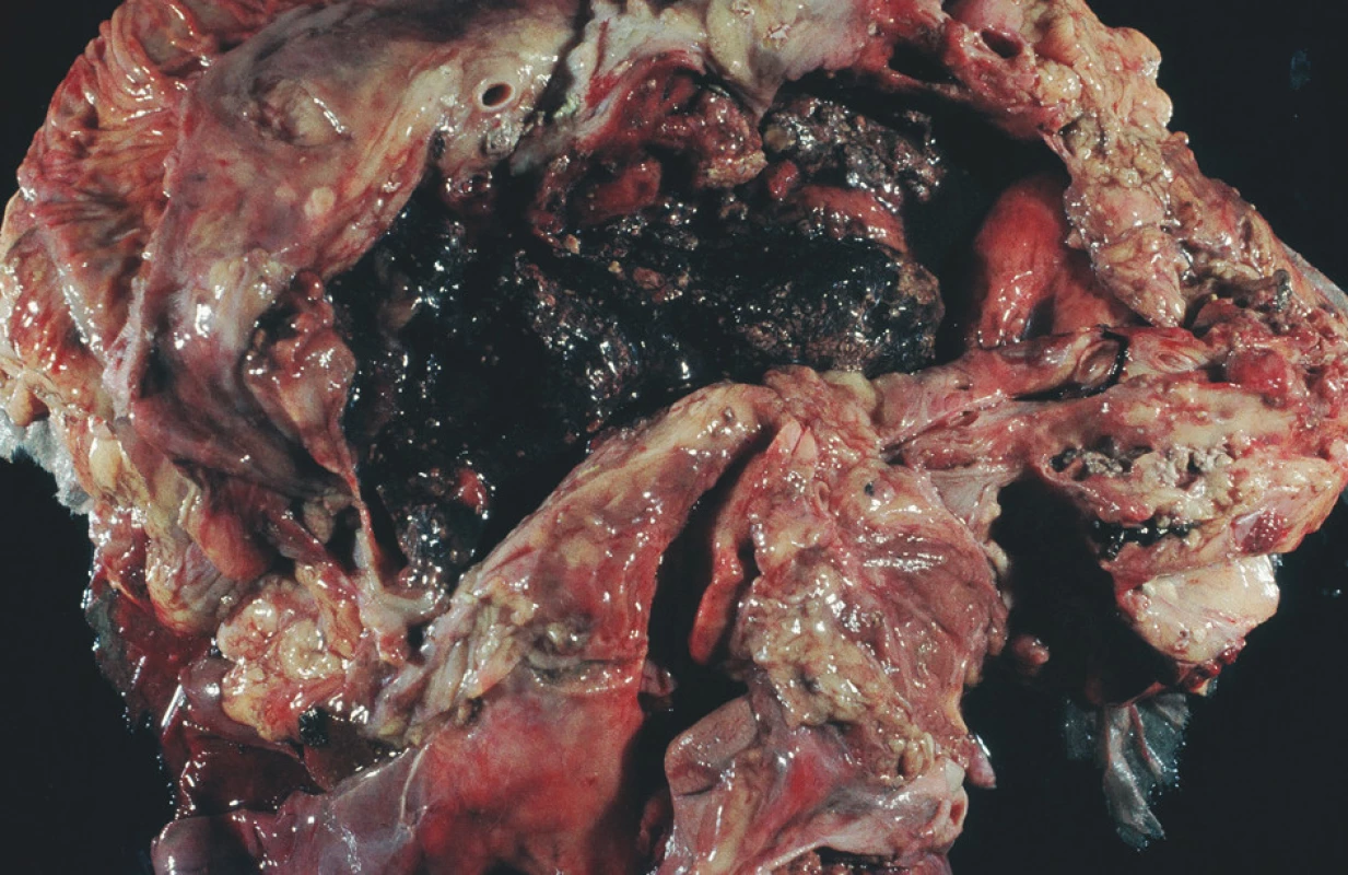 FAP – sekční nález, rozpad pankreatu – anamnéza 6 hodin
Fig. 1. FAP – section finding, destruction of the pancreas – a 6-hour history
(FAP = Fulminant acute pancreatitis)