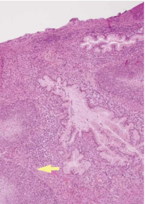 Histological examination showed no evidence of vascular and perineural invasion. Parameters and paracolpa with initial neoplasm involvement. Margins of vaginal exeresis, parameters, anterior and posterior radial free from neoplasia, even if close to it (margins less than 1 mm on the vaginal and radial margin). Pro liferative endometrium. Lymph nodes were removed bilaterally in the common iliac, external and internal iliac, and obturator stations; among these, a right obturator lymph node of approximately two centimeters in diameter was found to be the site of metastasis (yellow arrow). TNM staging: pT2ab pN1a (AJCC 9), FIGO stage IIIC1 (FIGO Cancer Report 2018). // Histologické vyšetření neukázalo žádný důkaz vaskulární nebo perineurální invaze. Parametry a paracolpus s počátečním nádorovým postižením. Okraje vaginální excize, parametry a přední i zadní radiála bez neoplazie, i když jsou jí blízko (okraje na vaginálním a radiálním okraji < 1 mm). Proliferační endometrium. Lymfatické uzliny byly odstraněny oboustranně na obvyklém místě ilea, vně i uvnitř, a na místě obturace; mezi nimi byla na pravé straně nalezena lymfatická uzlina o průměru cca 2 cm, která byla metastatickým ložiskem (žlutá šipka). TNM staging: pT2ab pN1a (AJCC 9), FIGO stadium IIIC1 (FIGO Cancer Report 2018).