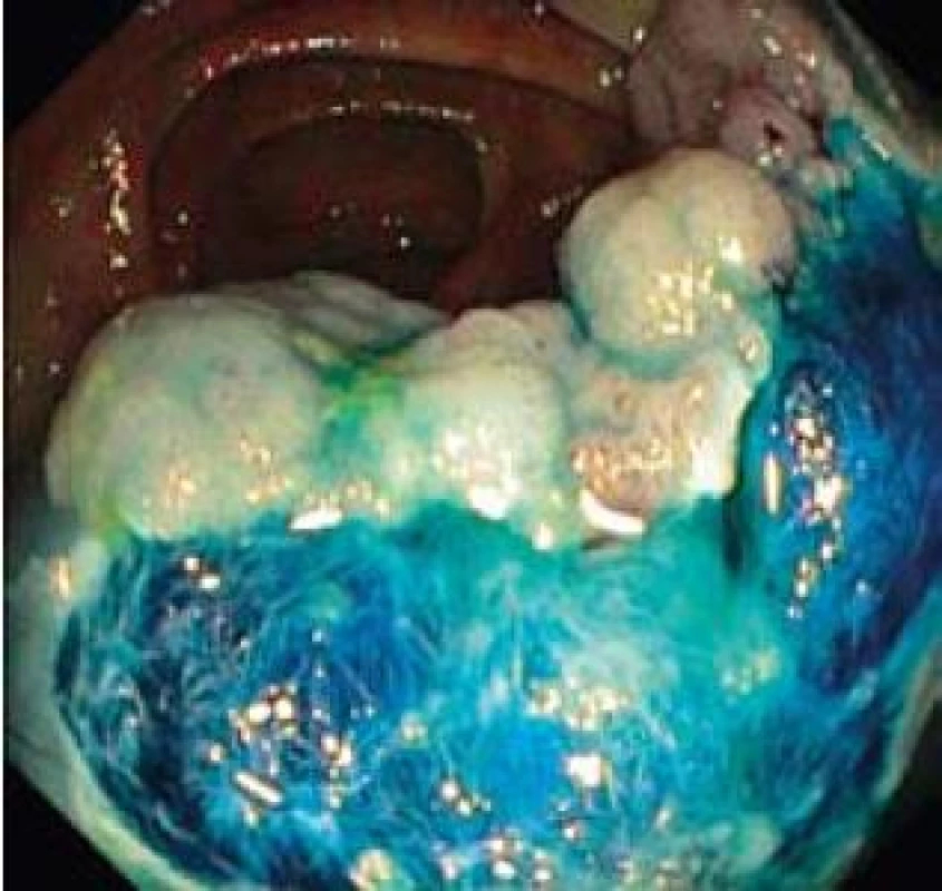 Endoskopická resekce kličkou po částech.
Fig. 3. Endoscopic piecemeal resection, lift-and-cut by snare.