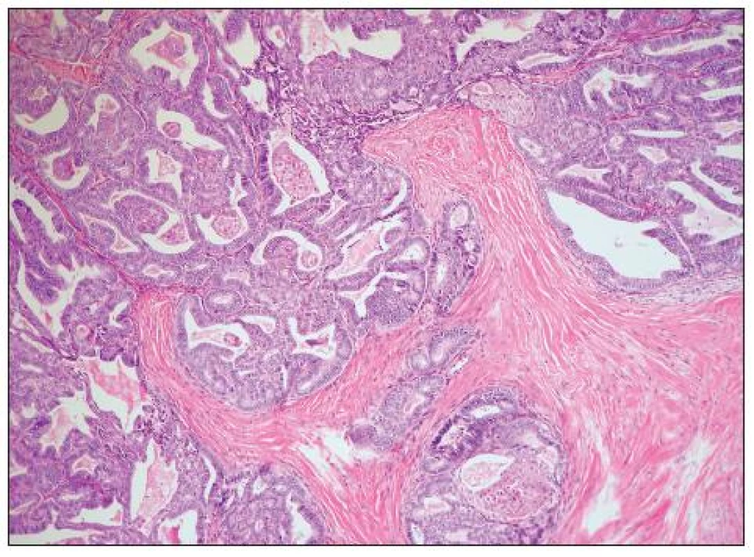 Dobře diferencovaný endometroidní adenokarcinom (G1) (HE, 100krát)