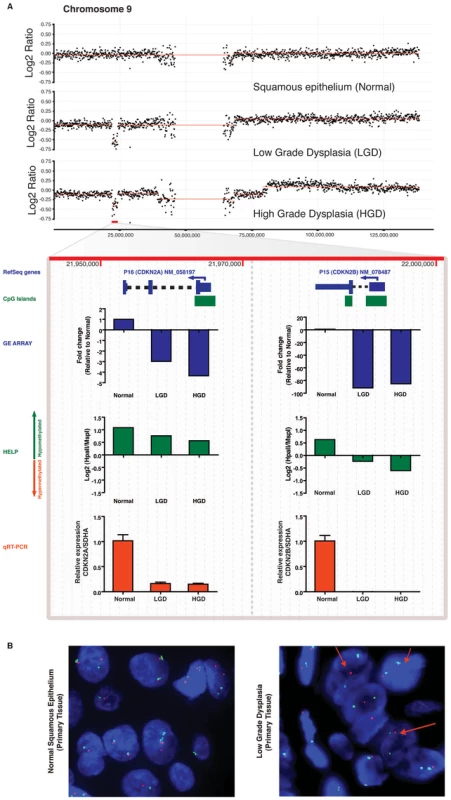 Differential inactivation of the <i>CDKN2A/CDKN2B</i> locus by combination of genomic and epigenetic mechanisms.