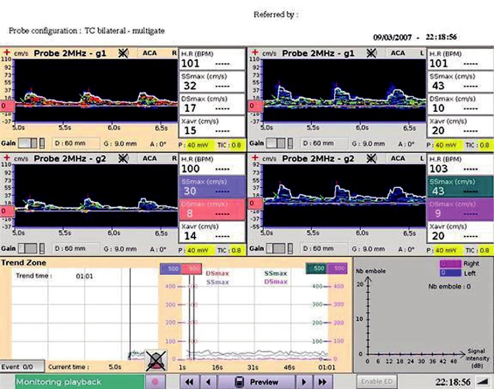 TCD záznam Zobrazuje snížené maximální rychlosti v systole a diastole (SSmax a Dsmax) a sníženou průměrnou maximální rychlost (Xavr).
