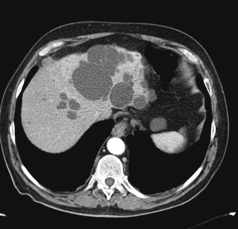 Polycystóza jater typu Gigot II. Vyšetření výpočetní tomografií s kontrastní látkou. Vícečetné cysty postihující část jaterního parenchymu, největší velikosti 6,5 cm 
Fig. 2. Hepatic polycystosis, Gigot’s type II. Contrast CT examination. Multiple cysts affecting a part of the hepatic parenchyma, the largest one of 6.5 cm