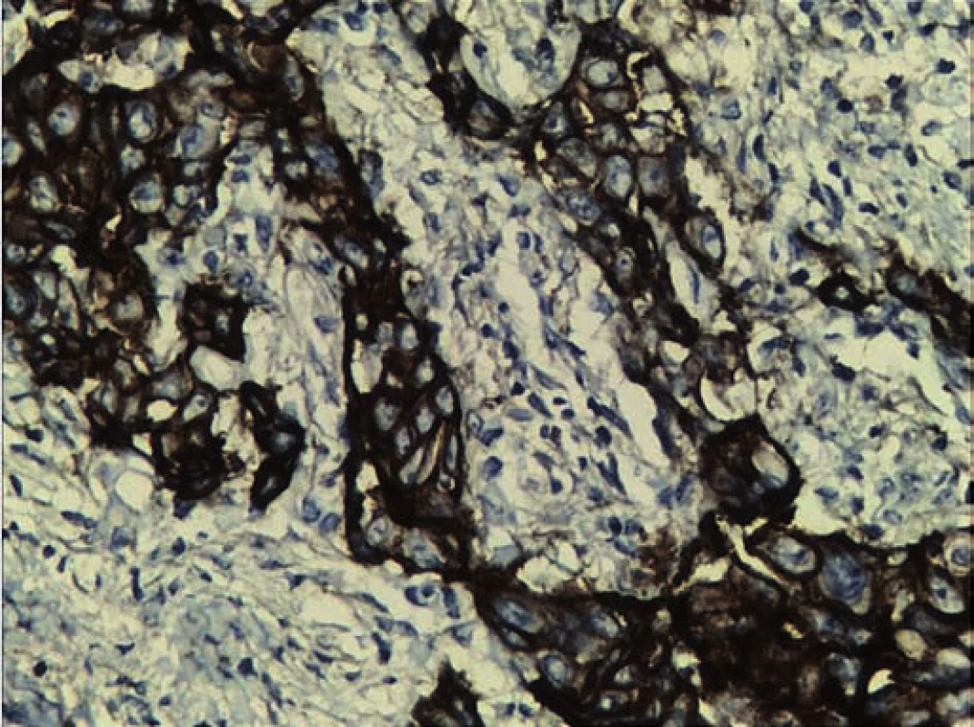 Immunohistochemistry photograph showing positive immunoreactivity for EGFR.