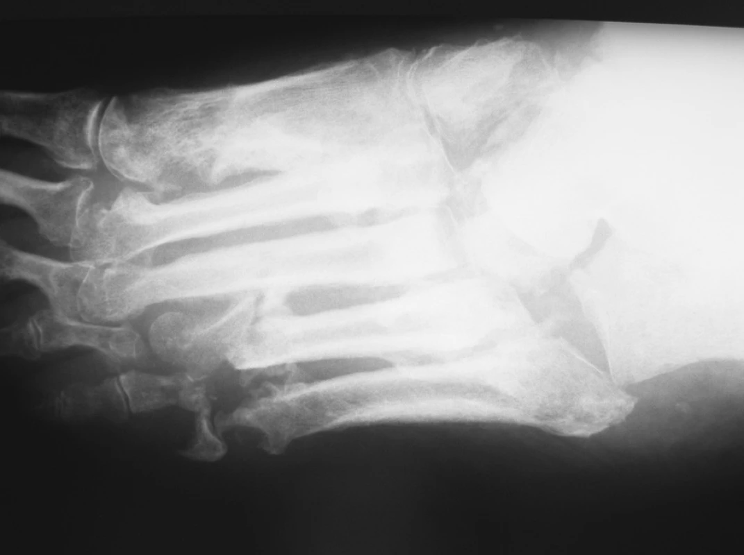 RTG pacienta s difuzní CHOA – indikace k ZF a komplementární osteosyntéze K-dráty
Fig. 2. X-ray view of a patient with diffuse CHOA – indication for external fixation and complementary osteosynthesis with K-wires