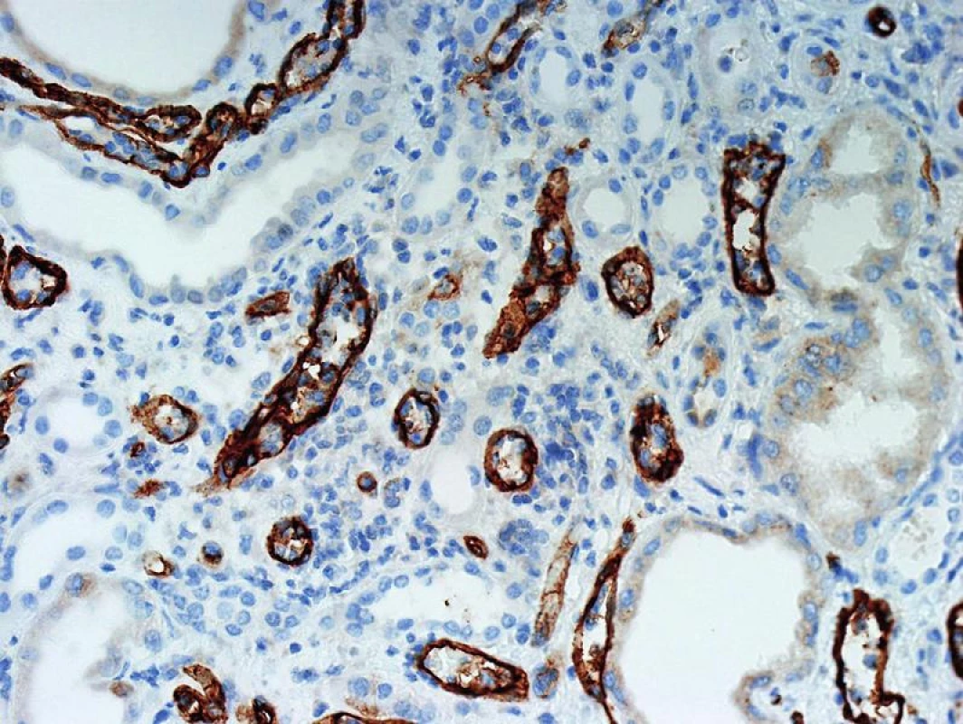 Imunohistochemický průkaz C4d má nižší senzitivitu a detekce, která je v tomto průkazu fokální bývá v IF difúzní. Tomu jsou přizpůsobena i hodnotící kriteria (objektiv 20x).