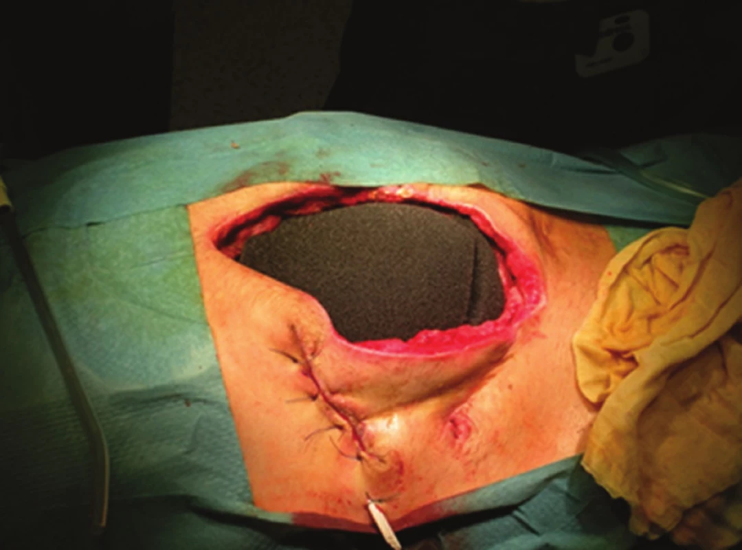 Vnitřní vrstva laparostomie
Fig. 2: The inner layer of TNP laparostomy