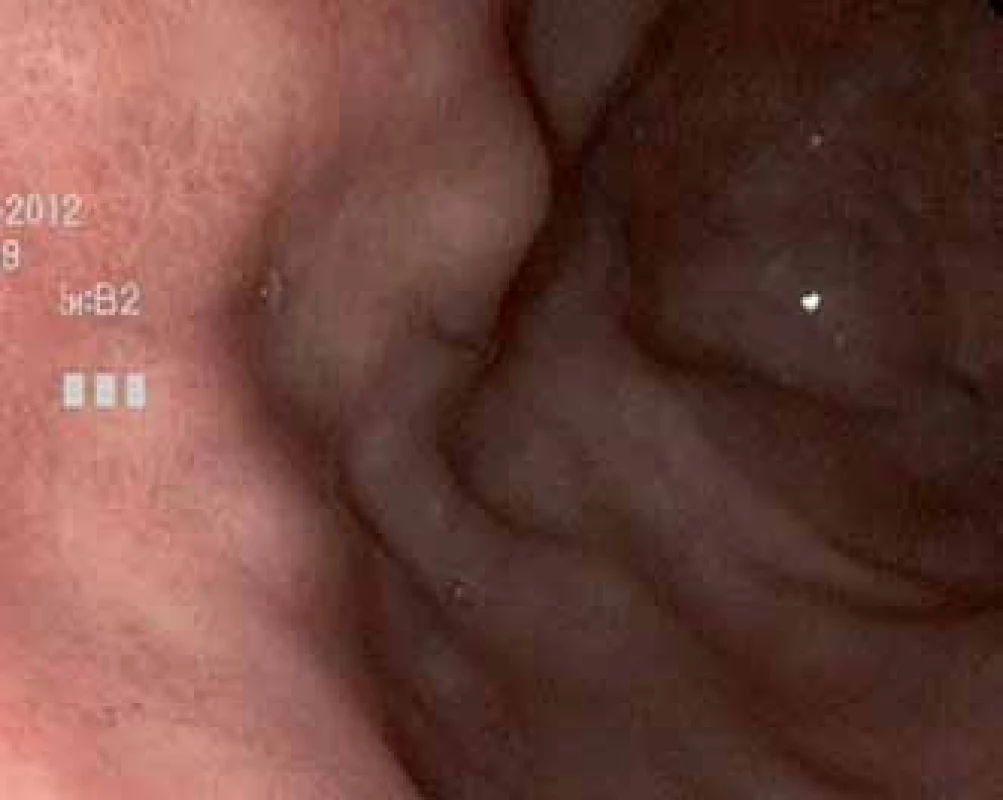 Gastroskopický obraz žaludku po imunochemoterapii a radioterapii MALT lymfomu žaludku.