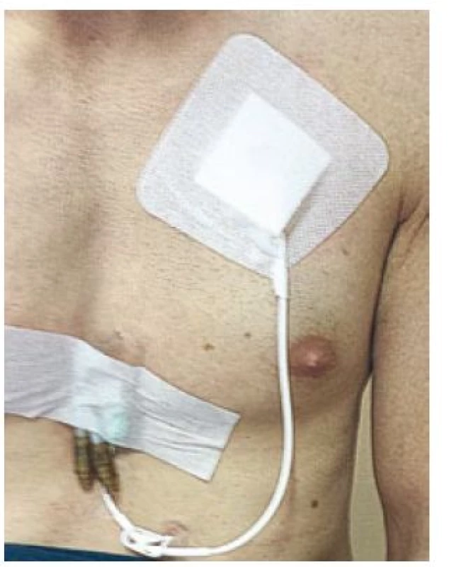 Implantovaný Hickmanov katéter.
Fig. 2. Hickman catheter implanted.
