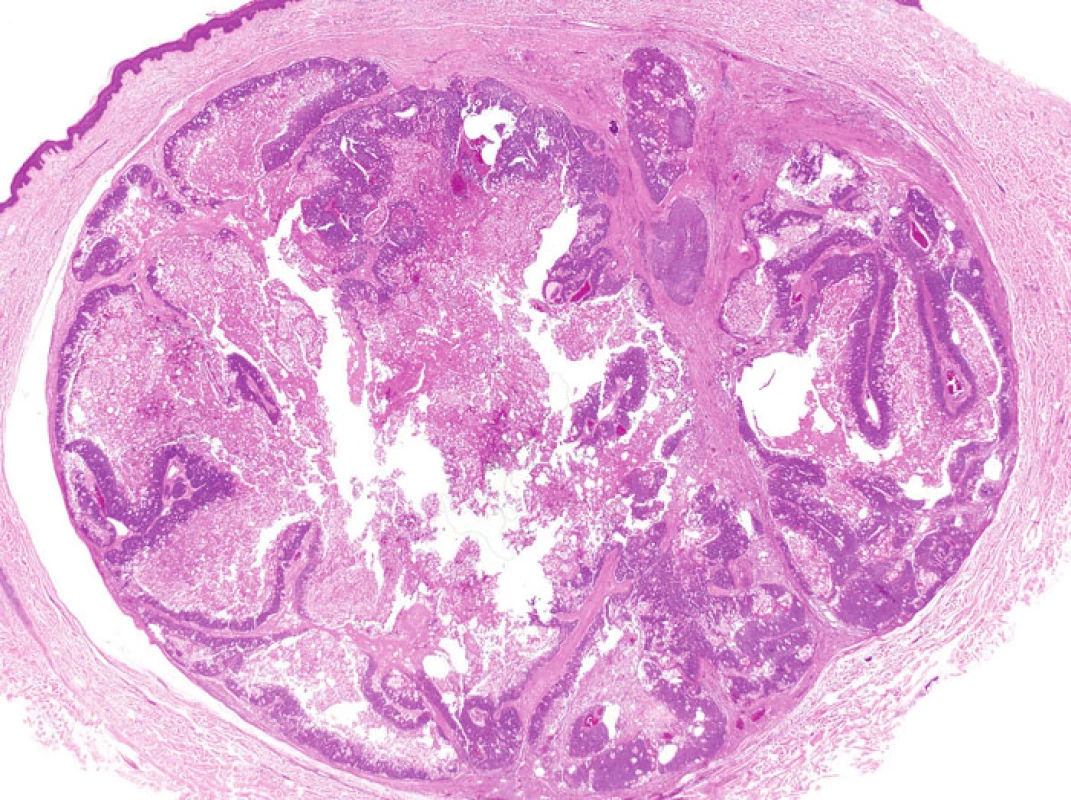 Tzv. cystický sebaceózní tumor s výraznou cystickou přestavbou