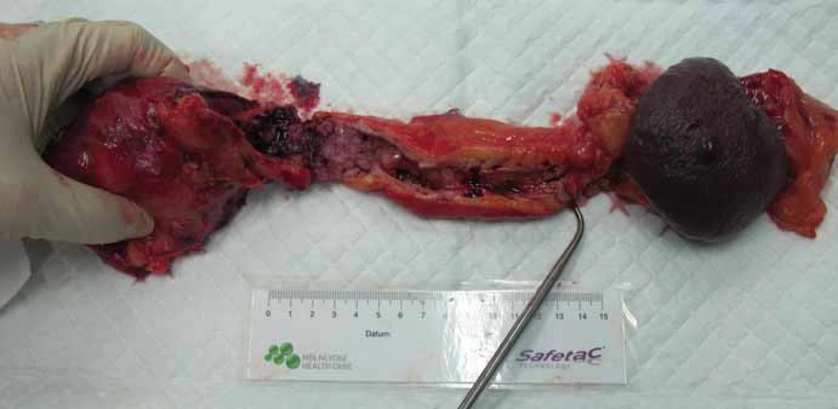 Totální pankreatektomie u nemocného s IPMN – resekát.
Fig. 1. Total pancreatectomy in patients with IPMN – the biopsy.