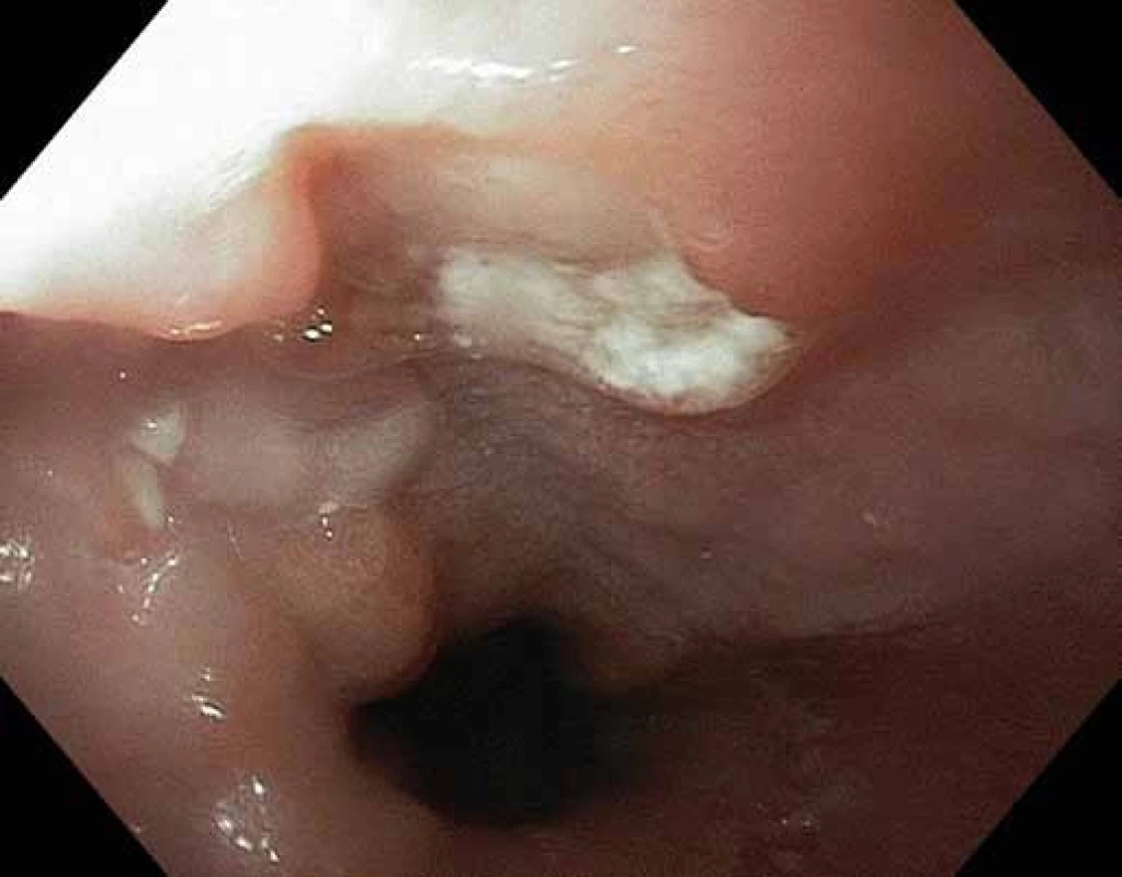 Typický vřed jícnu vzhledu sopky.
Fig. 1. Typical esophageal ulcer with volcano-like appearance.