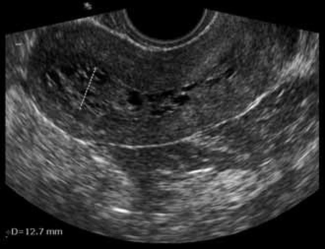 USG – cystická atrofie při léčbě tamoxifenem.