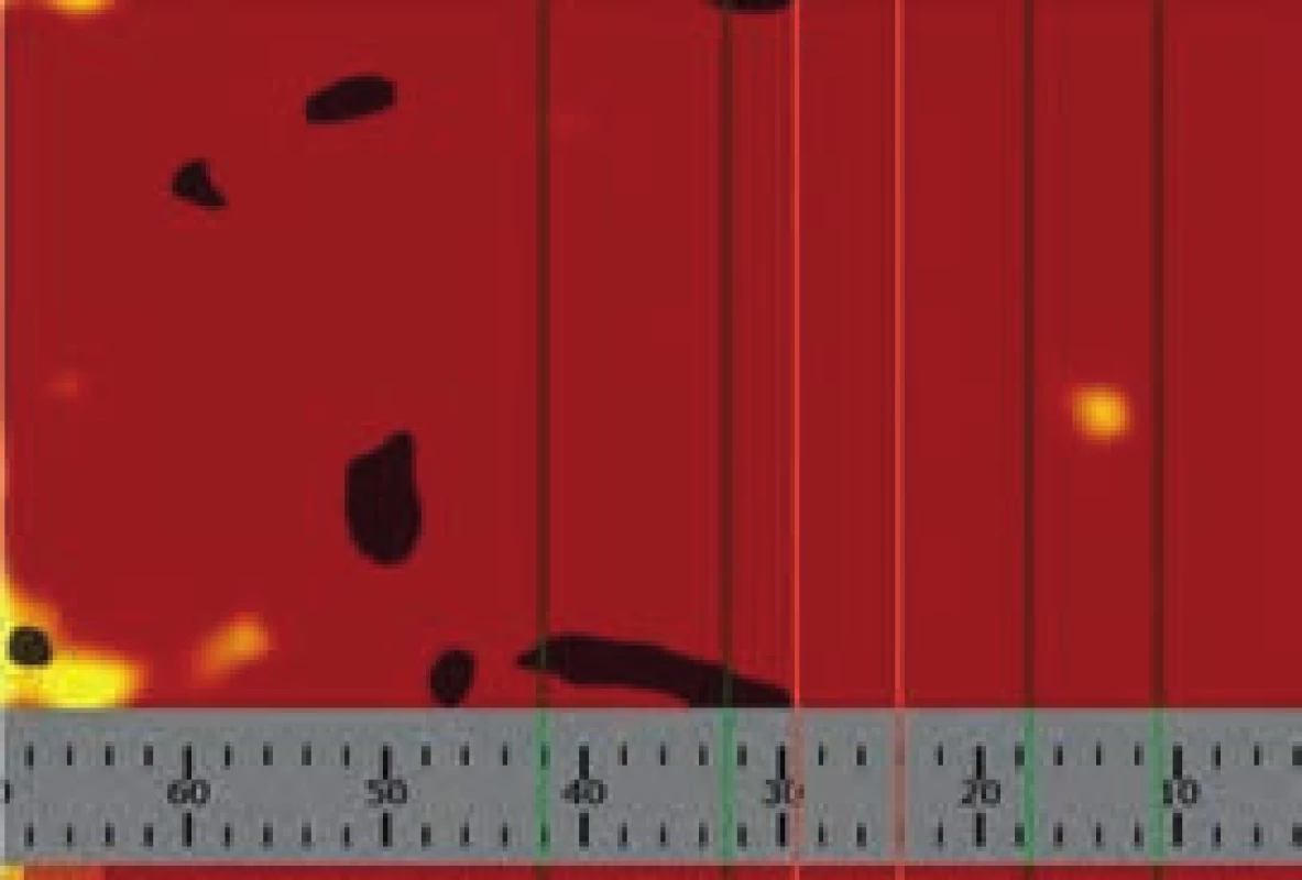 Plošný chemogram po revaskularizaci