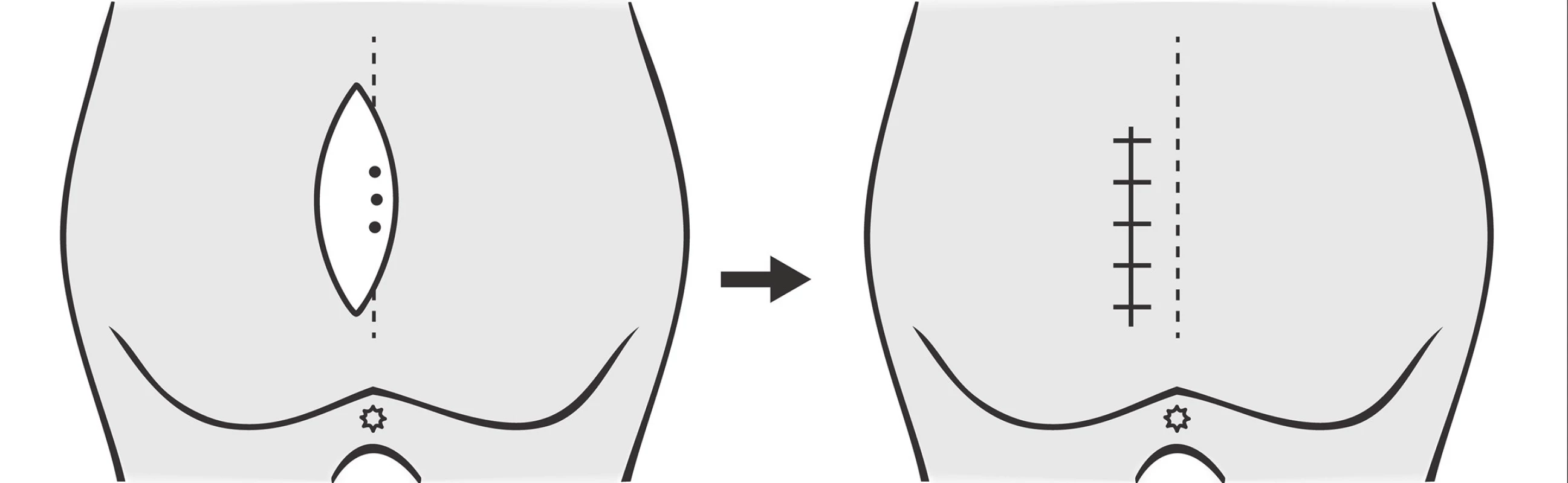 Karydakisův posun
Fig. 1: Karydakis flap