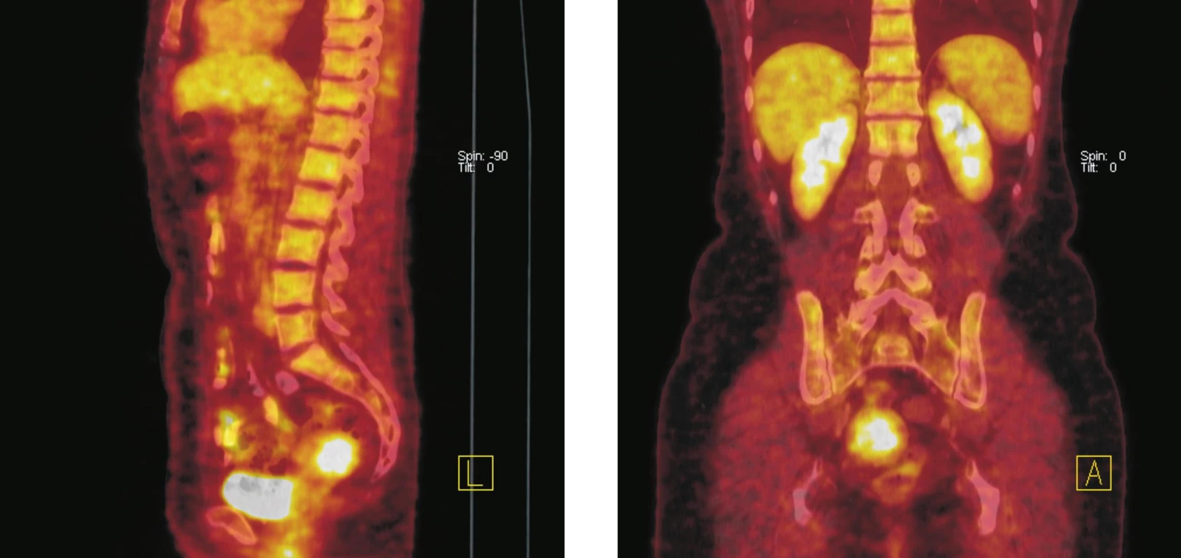 Fúze PET a CT řezů–sagitální rovina (vlevo), koronální rovina (vpravo). Ve fundu dělohy lze na CT diferencovat hyperdenzní formaci o průměru 36 mm se zvýšenou akumulací <sup>18</sup>F-FDG. Po srovnání klinických a ultrazvukových nálezů z posledních 5 let (gynekolog) a vstupního CT vyšetření bylo konstatováno, že se jedná o stacionární leiomyom děložního těla. Kontrolní <sup>18</sup>F-FDG PET/CT vyšetření o rok později potvrdilo neměnnost nálezu.