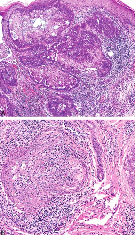 Peritumorální lymfocytární infiltrace sebaceózního adenomu (A); intra- a peritumorální lymfocytární infiltrace sebaceomu (B)