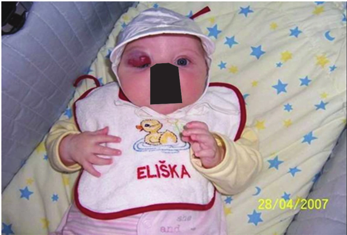 Superficiální hemangiom pravého horního víčka u dvouměsíčního kojence před terapií