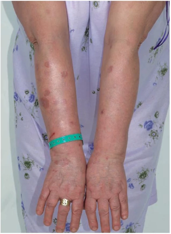 Granuloma anulare – mnohačetná anulární ložiska