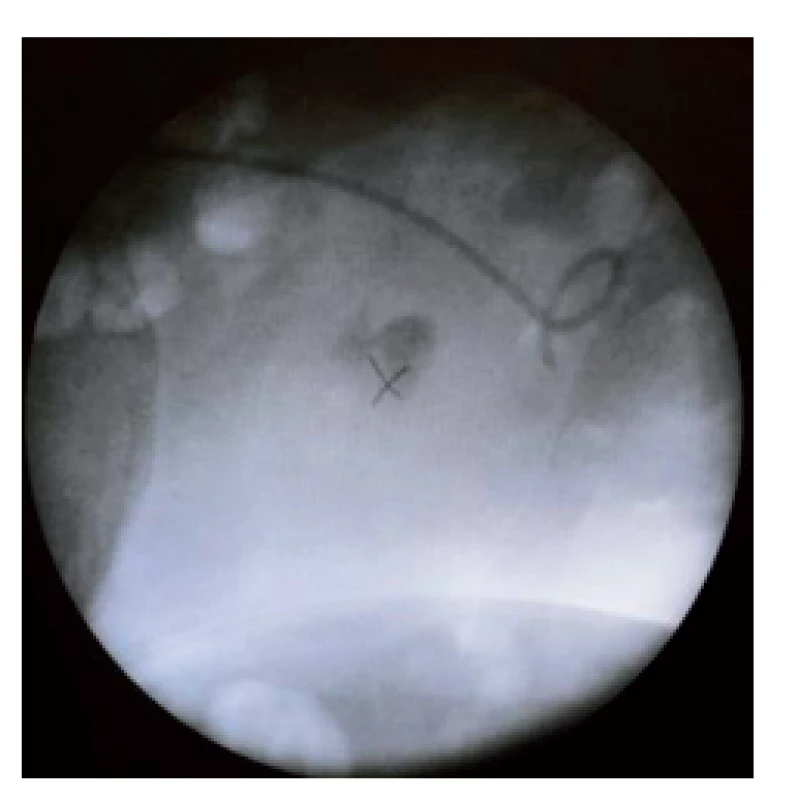 Zaměření 13 mm sytě kontrastní pyelolitiázy do ohniska přístroje – pacient po relokaci objemné proximální ureterolitiázy se zavedeným uretrálním stentem
Fig. 2. Aiming of 13mm pyelolithiasis to the focus of instrument – patient with ureteral stent after relocation of voluminious proximal ureterolithiasis