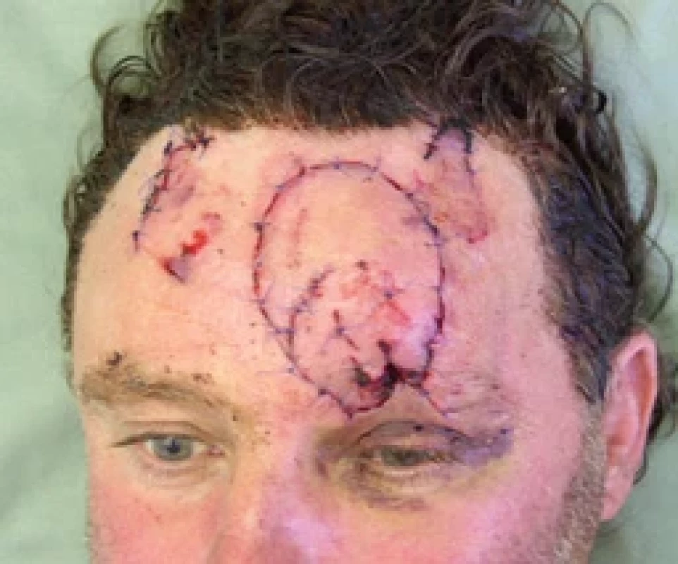 Fifth post-op day during dressing change. Source: archive of authors.