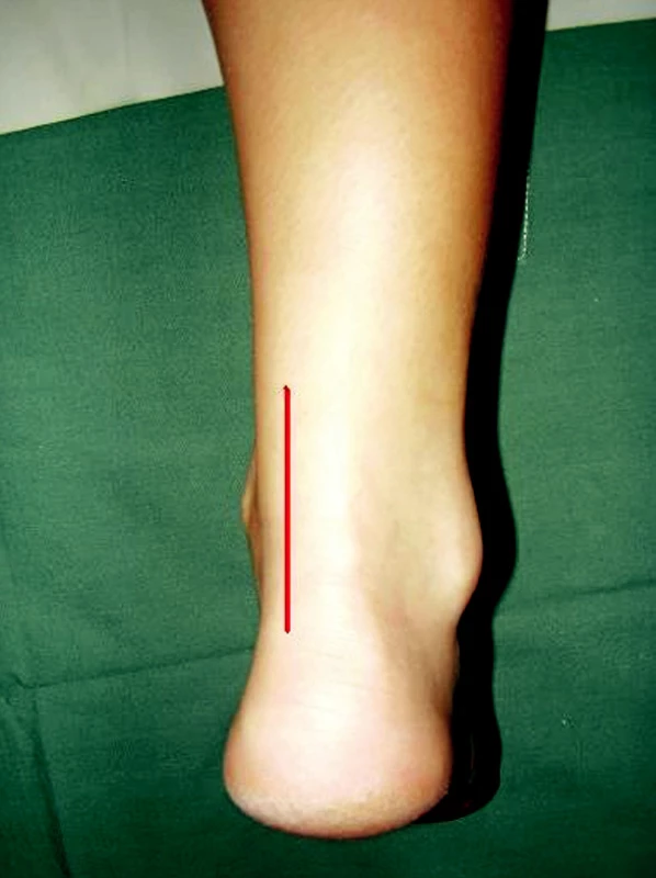 Posteromediální přístup k ruptuře Achillovy šlachy
Pic. 1. Posteromedial approach in a case of Achilles tendon rupture