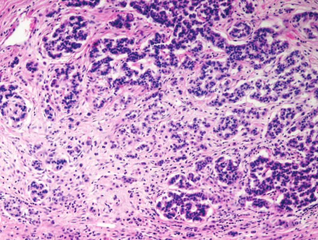 Chronická pankreatitida (CP). Pseudohyperplastická a pseudoinfiltrativní morfologie ostrůvku endokrinního pankreatu v terénu CP. Blandní cytologie, centrálně lokalizovaná jádra a charakteristická chromatinová kresba („pepř a sůl“) favorizují diagnózu benigní struktury. Barveno hematoxylinem eozinem (zvětšení 100x).