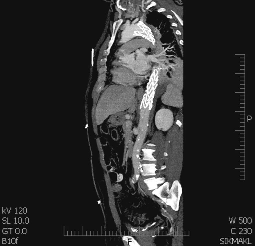 Stentgraft hrdlem překrývá levou a. subclavii a končí nad viscerálním segmentem
Fig. 3. A stentgraft covering the left subclavian artery and ending cranial to  the visceral segment