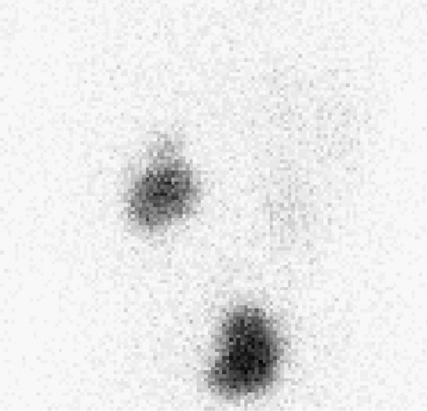 Kontrolní scintigram po skončení studie, po vertikalizaci a po mikci u téhož pacienta. Přetrvává retence aktivity v dilatovaném dutém systému levé ledviny.
Fig. 4. A control scintigraphy after the end of the study, after verticalization and aftermicturition in the same patient; in the hollow system of the left kidney the activity in the dilated systemis retained.