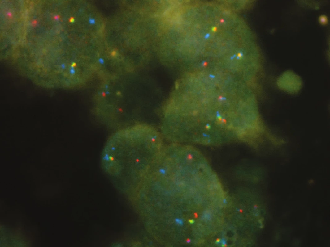 Inverze genu <i>ALK</i> se ztrátou intersticiální DNA (samostatné červené signály, zelené signály chybí) s účastí <i>EML4</i> jako fúzním partnerem (modré signály), zvětšení 1000x.