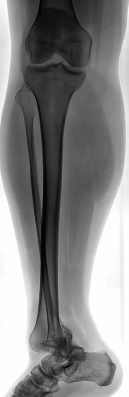 Rtg příznak (knee anterior – foot lateral) </br> A radiographic sign (knee anterior – foot lateral)