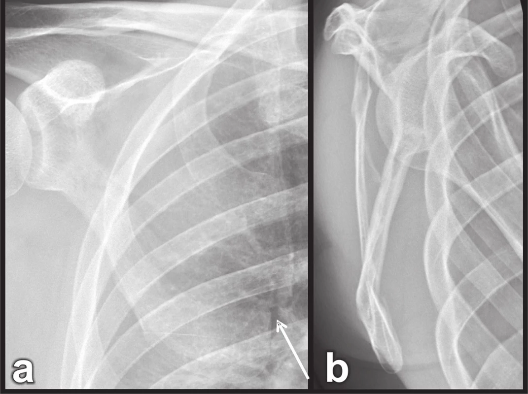Zlomenina celého dolního úhlu s ventrální anulací
a – dorzální pohled, b – mediální pohled.
Fig. 4: Fracture of the entire inferior angle with anterior angulation
a – posterior view, b – medial view.