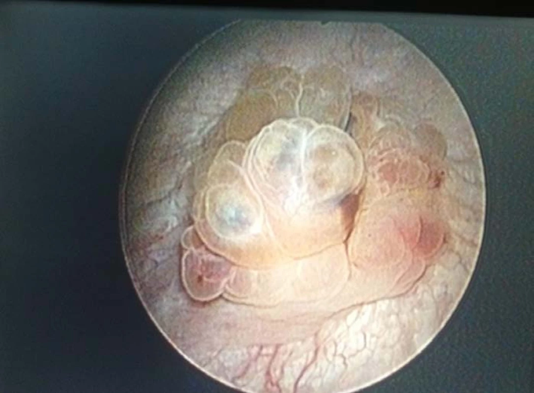 Pohled na ložisko endometriózy v močovém měchýři.