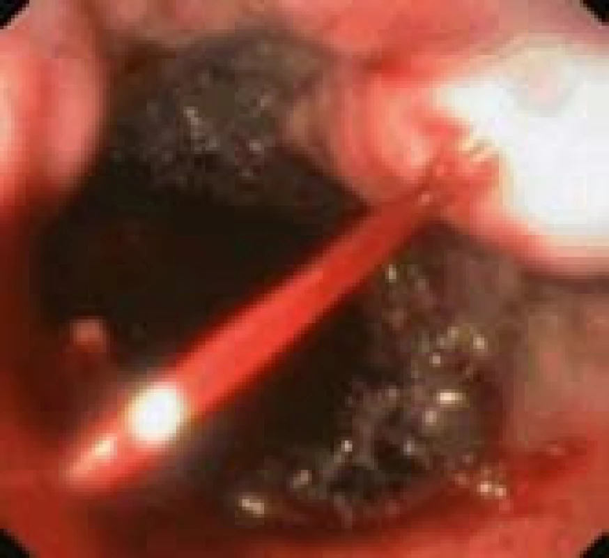 Akutní krvácení z varixu jícnu (nemocný s jaterní cirhózou).
Fig. 1. Acute bleeding from oesophageal varix (patient with liver cirrhosis).