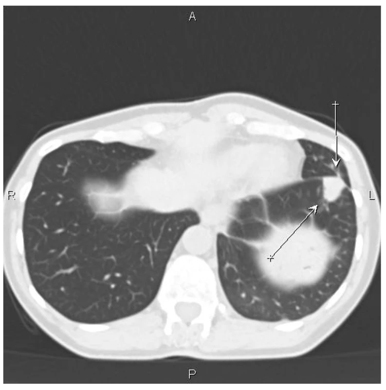 CT nález – šipky označují ložisko v levé plíci<br>
Fig. 3: CT scan – arrows indicate the focus in the left lung