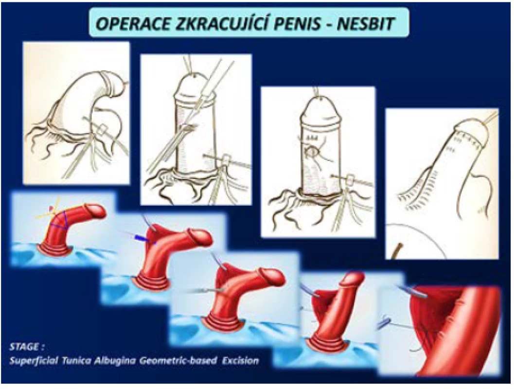 Operace zkracující penis – Nesbit (4)
Fig. 13 Shortening procedures of penis – Nesbit (4)