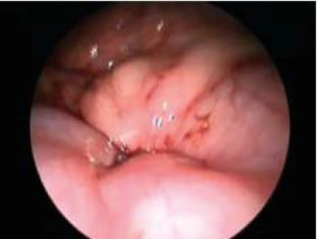 Laparoskopická verifikace uzávěru celé žaludeční stěny (seróza-seróza).
Fig. 2. Laparoscopic verification of the whole abdominal wall closure (serosa-to-serosa).