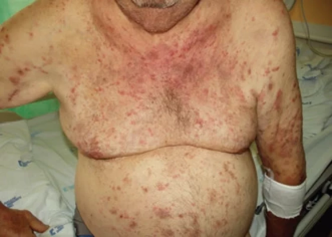 Kožní změny při VEXAS syndromu, dermatologická diagnóza byla neutrofi lní dermatitida, Sweetův syndrom.