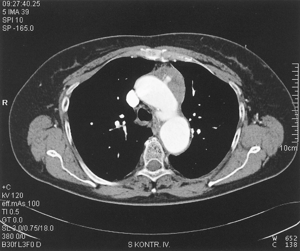 Pseudoaneurysms of the aortic arch
Obr. 1. Pseudoaneurysma oblouku aorty