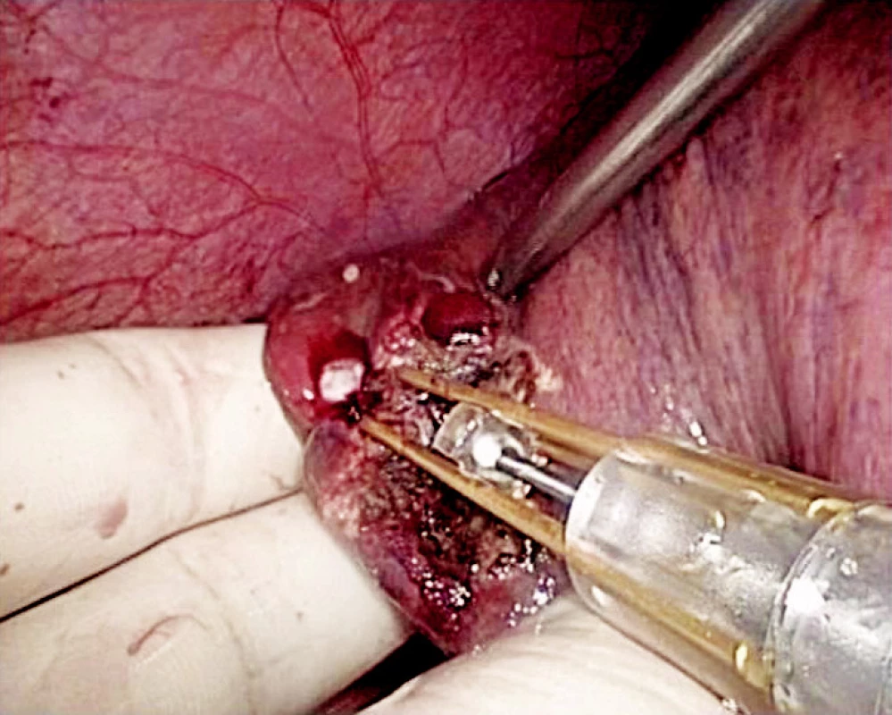 Ablace jaterního parenchymu s použitím Laparoscopic Habib 4X
Fig. 5. Liver parenchyma ablation using Laparoscopic Habib 4X