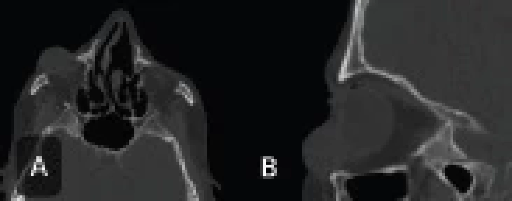 Spiral orbital CT scan (without contrast) in axial (A) and saggital (B) views showing a homogenous, well-defined solid mass in the right lower lid