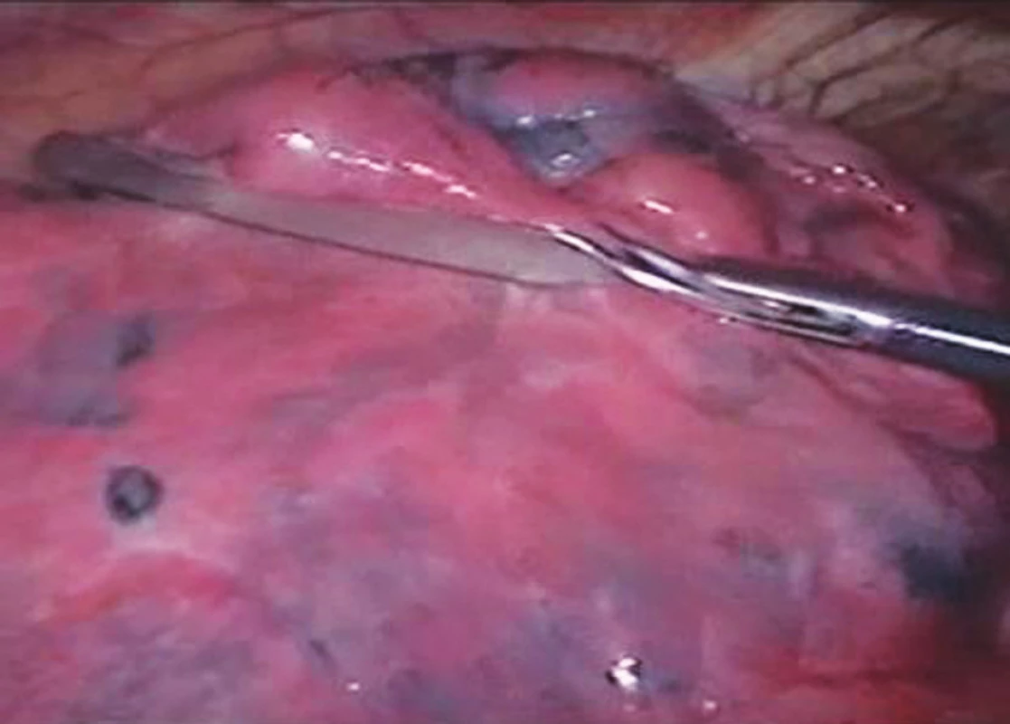 Vyšetření plicní tkáně atraumatickým grasprem
Pic. 1. Examination of pulmonary tissue using an atraumatic grasper