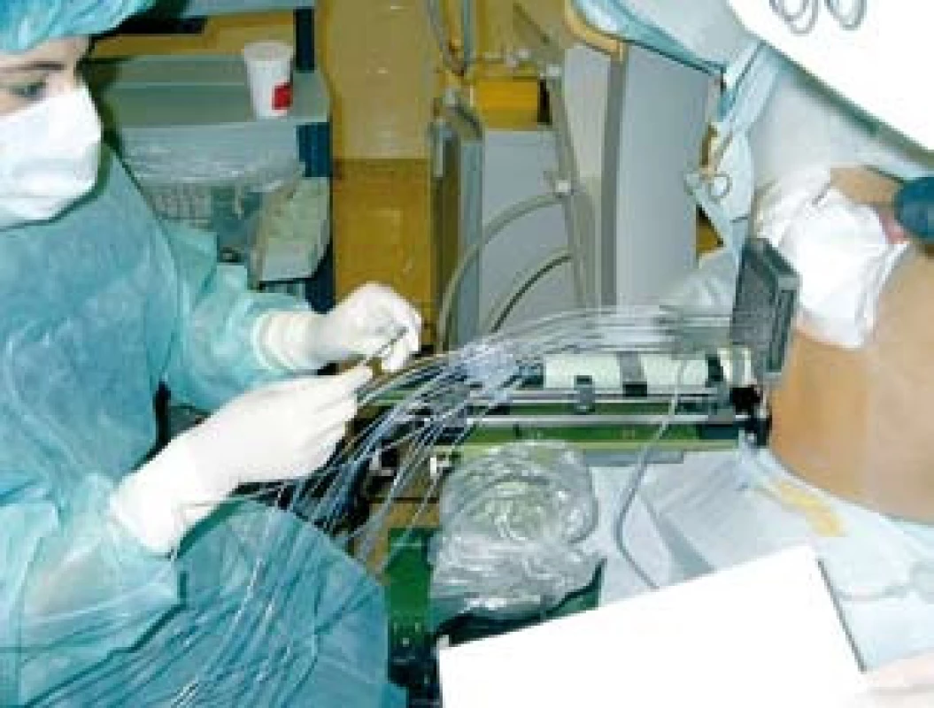 Transperineální aplikace jehel pod kontrolou transrektálního ultrazvuku
Fig. 1. Transperineal insertion of needles into prostate using ultrasound guidance