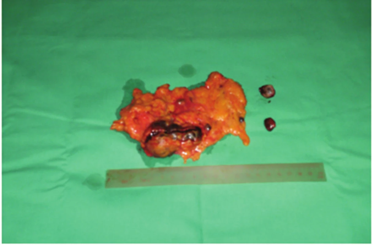 Odstránená časť omenta s implantovaným tkanivom sleziny a dve samostatné ložiská
Fig. 2: Removed part of the omentum with implanted splenic tissue and two separate deposits