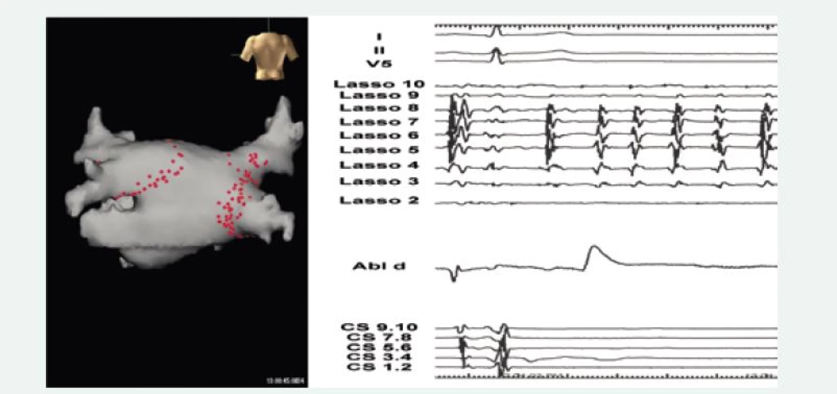 Ukázka elektroanatomické mapy levé síně se schématem lézí, které vedly k izolaci plicních žil u nemocného s paroxyzmální fibrilací síní (levý panel, pohled zezadu). 